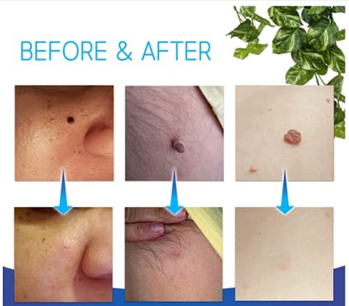 SKIN TAG - Medicinski flasteri za bubuljice, akne, bradavice