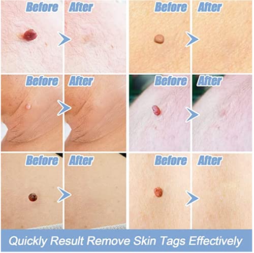 SKIN TAG - Medicinski flasteri za bubuljice, akne, bradavice