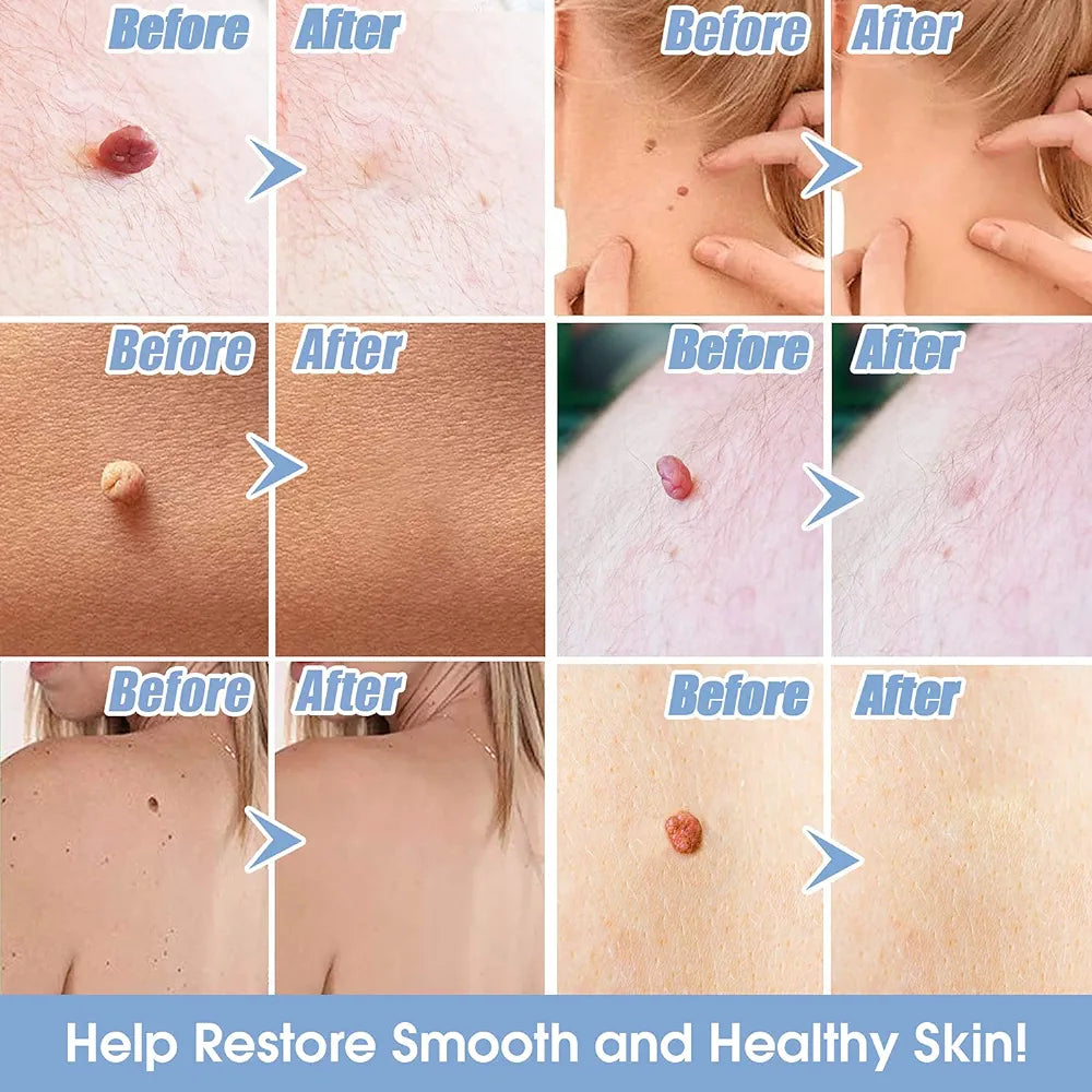 SKIN TAG - Medicinski flasteri za bubuljice, akne, bradavice